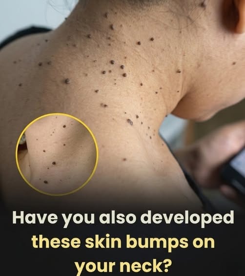 Why Skin Tags Appear